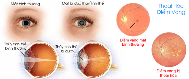 Tác hại của ánh sáng xanh